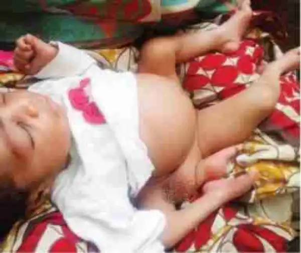 Lady Gives Birth To A Baby With 4 Legs, 2 Genitals In Katsina State